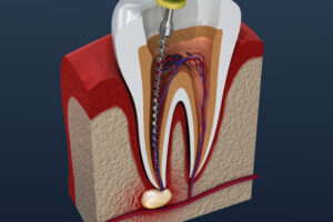 dallas root canal