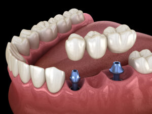 dallas dental implant bridge