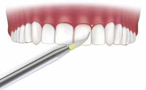 dallas dental lasers